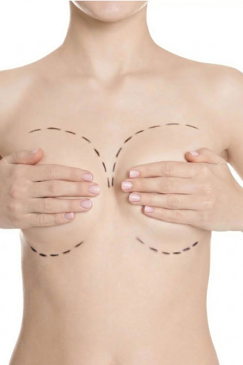 Breast Augmentation
