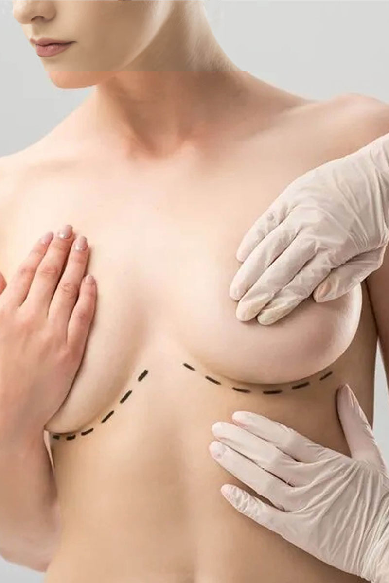 Breast Lift