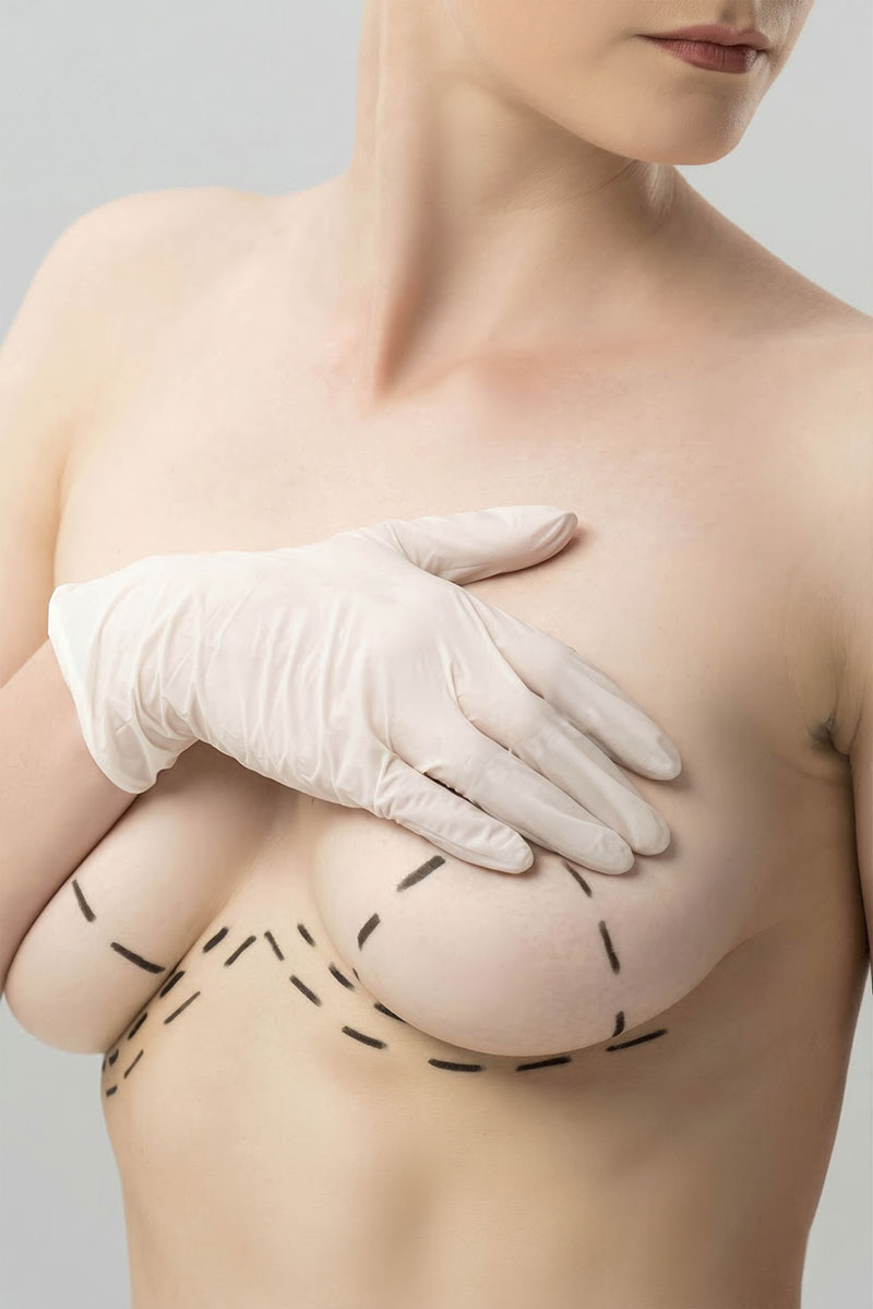 Breast Reduction